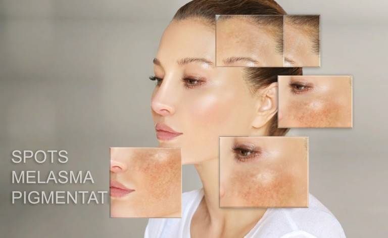 Pigmentflecken: Ursachen & Behandlung - GoAesthetic
