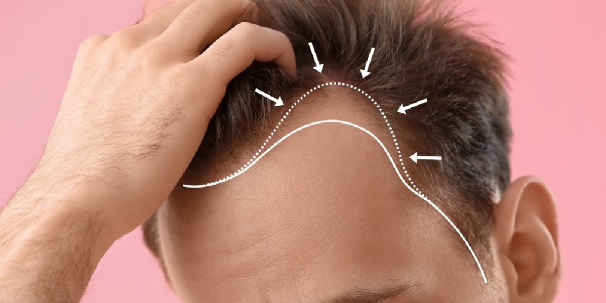 PRP Behandlung Haare Wien